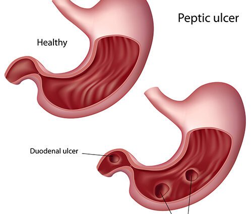 Stomach ulcer and duodenal ulcer (peptic ulcer)