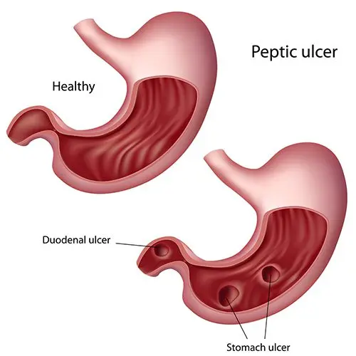 Stomach ulcer and duodenal ulcer (peptic ulcer)