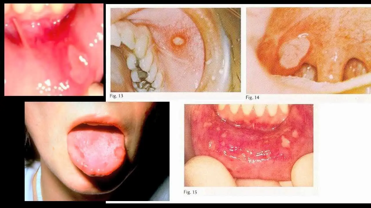 Stomatitis: folk remedies. Video