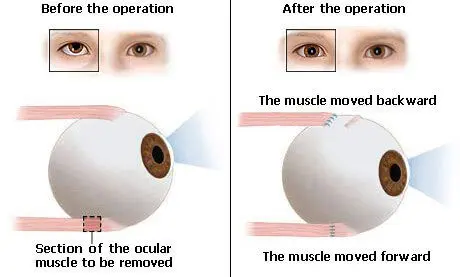 Strabismus: when to have an operation?