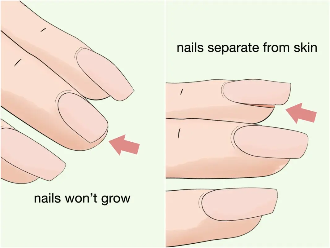 Strengthening nails