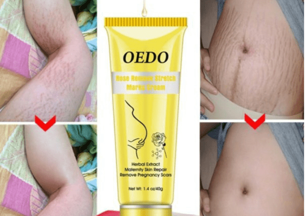 Stretch mark cream: how to remove stretch marks at home? Video