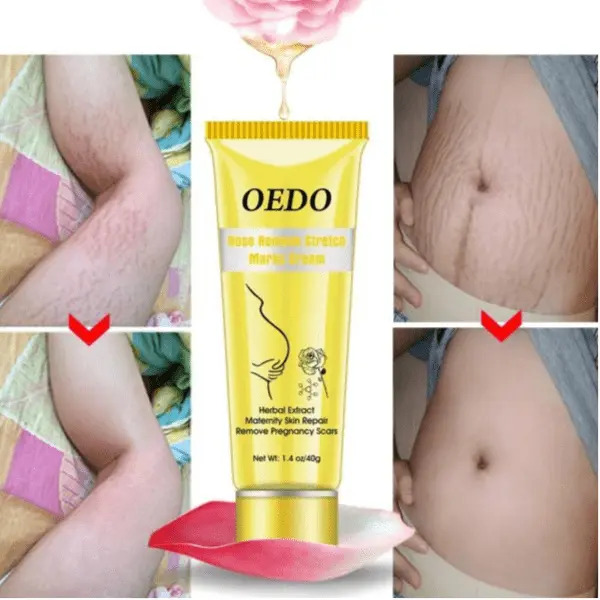 Stretch mark cream: how to remove stretch marks at home? Video