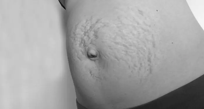 Stretch marks and absence of a navel: 7 imperfect models