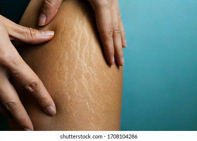 Stretch marks on the legs: how to get rid of. Video