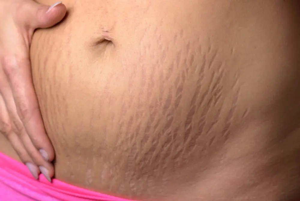 Stretch marks on the stomach after pregnancy: photo