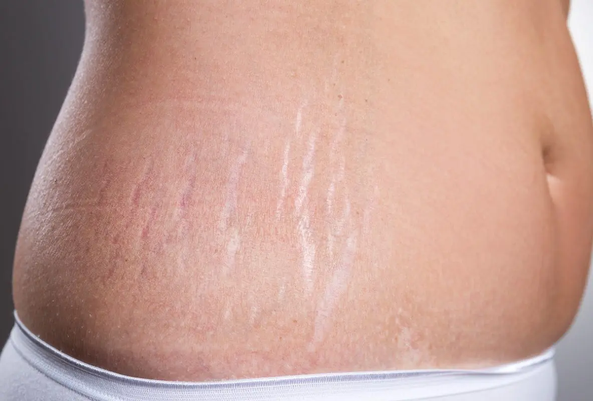 Stretch marks