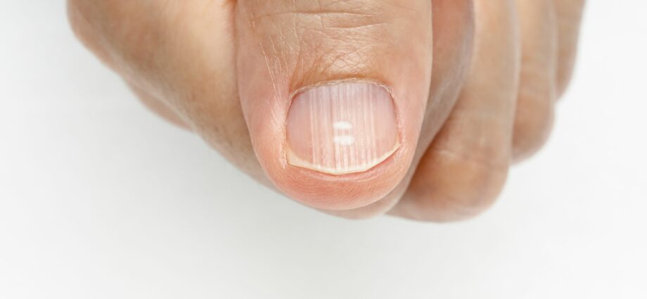 Prskani nokti: šta briga za prugaste nokte?