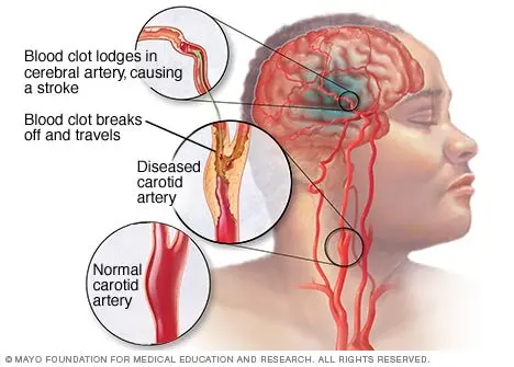 Stroke