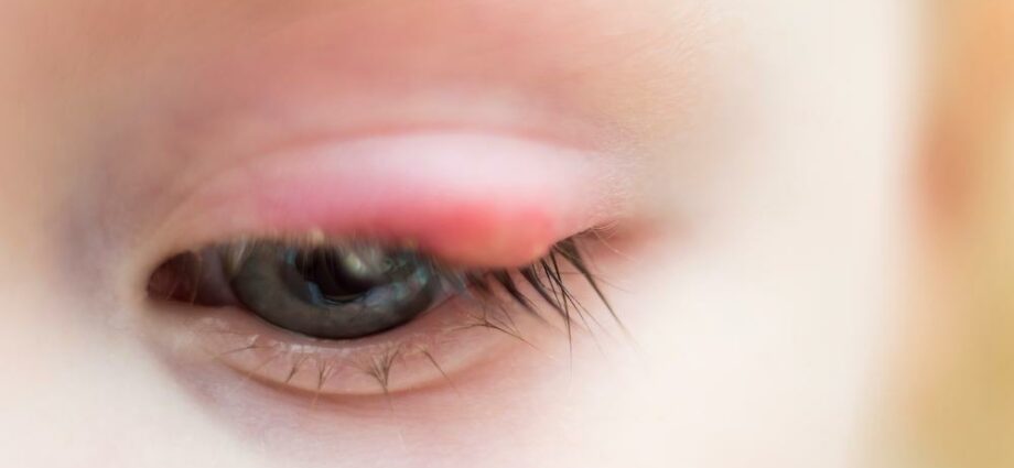 Stye in children: how to recognize it and treat it?