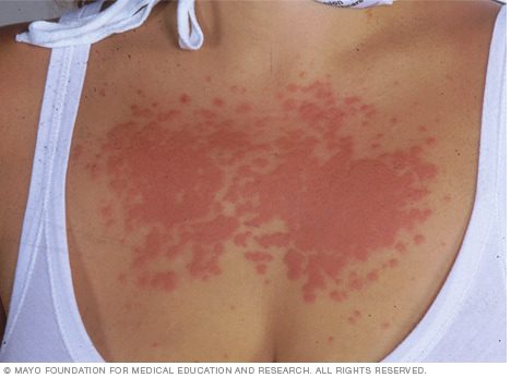 Алергија на сонце