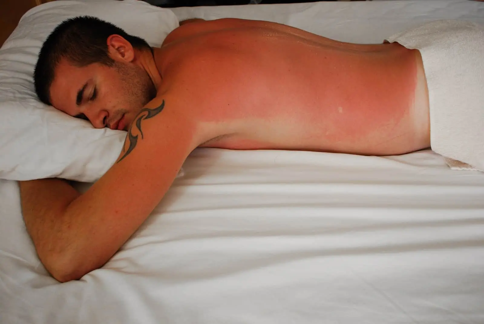 Sunburn and immunity: what happens while lying on the beach