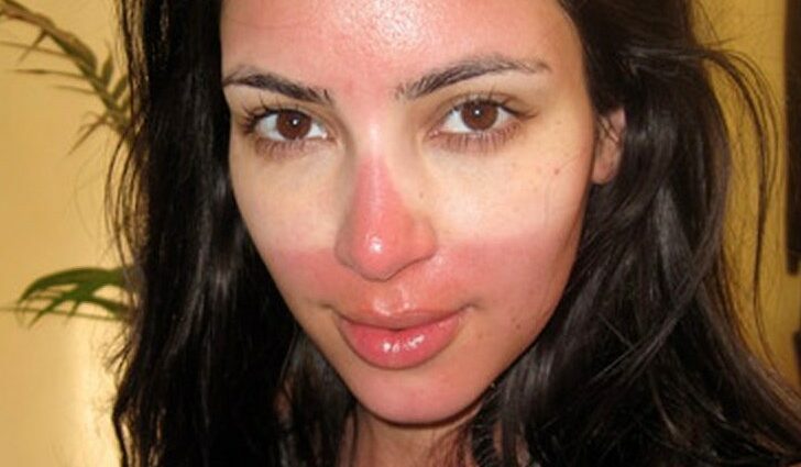 Sunburn of the face: what to do? Video