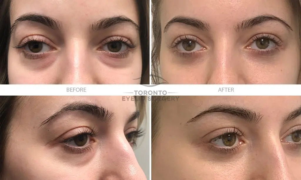 Surgery of eyelids, bags and dark circles: management of blepharoplasty