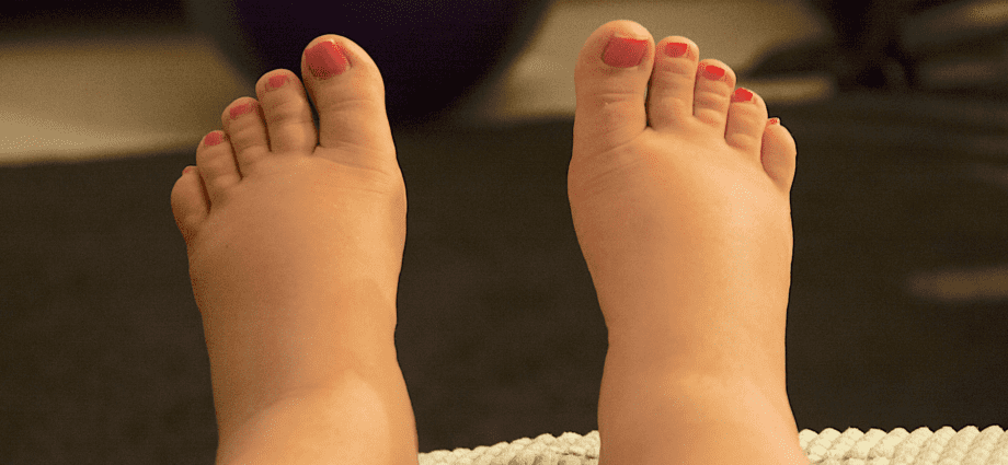 Swelling of the legs after cesarean, why the legs swell