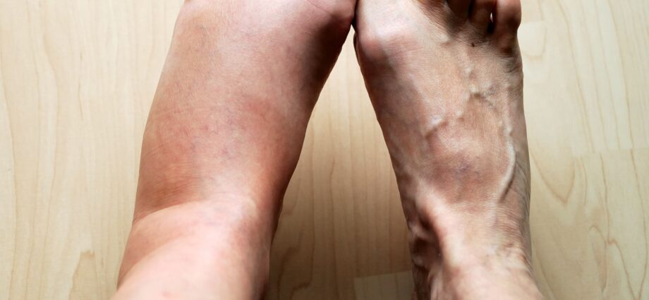 Хөл хавагнах: шалтгаан, эмчилгээ, урьдчилан сэргийлэх. Хөл чинь хавдсан байвал яах вэ