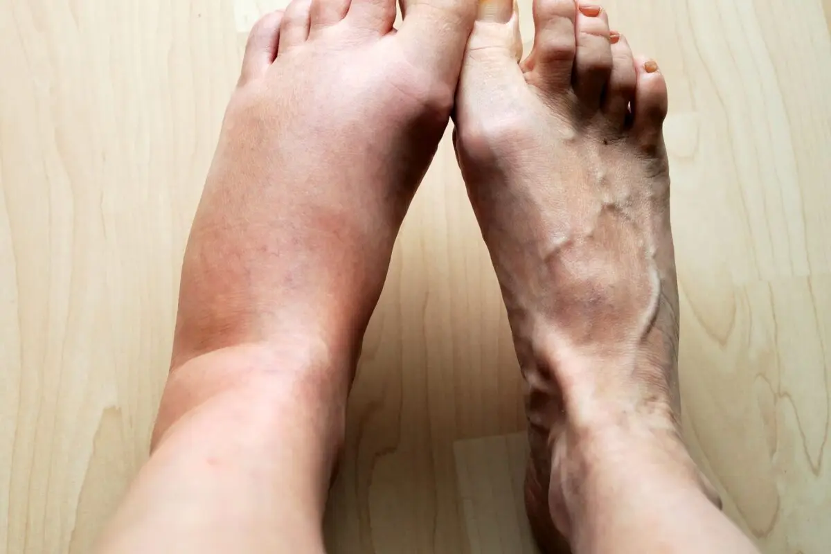 Swelling of the legs: causes, treatment, prevention. What to do if your legs are swollen