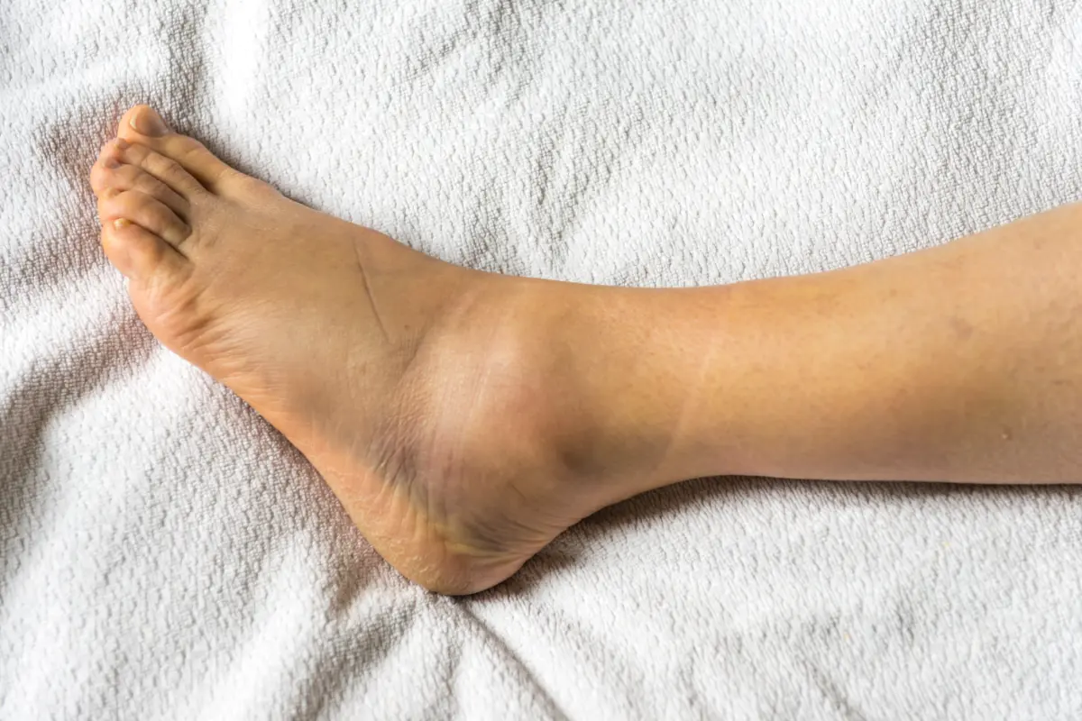 Swollen ankle: what to do when the ankle is sore?