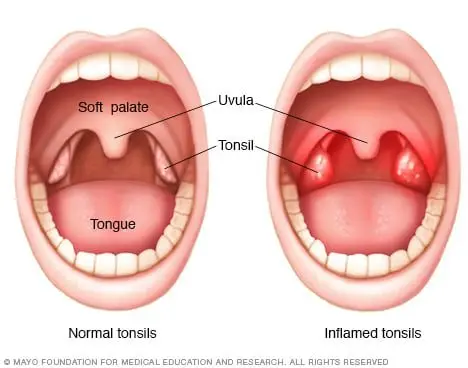 Swollen tonsils, which makes the tonsils swollen and painful to swallow