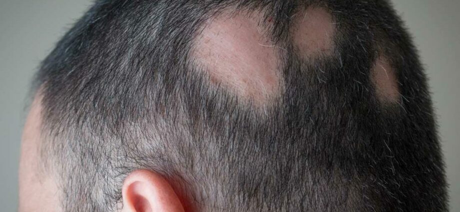 Gejala lan wong sing duwe risiko alopecia areata (ilang rambut)