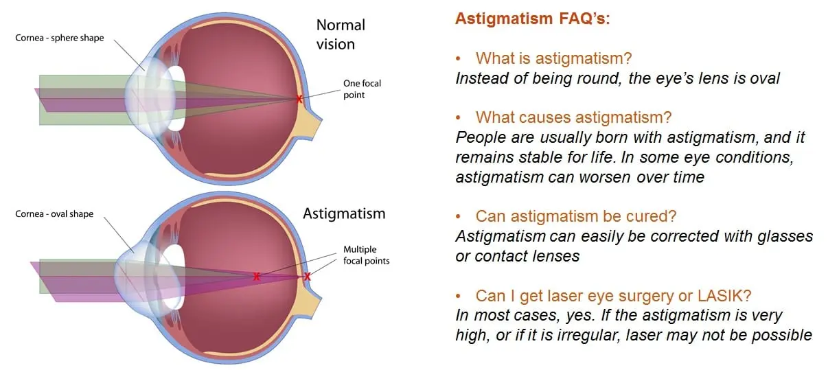 Symptoms and people at risk of astigmatism