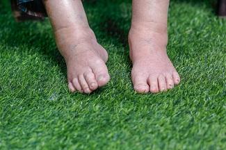 Сімптомы і людзі з групы рызыкі ацёкаў ног