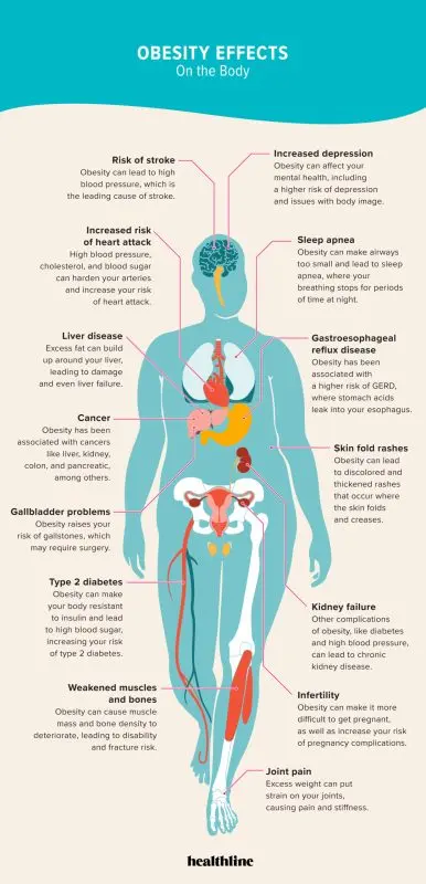 Symptoms and people at risk of obesity