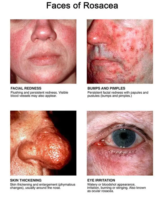 Symptoms and people at risk of rosacea