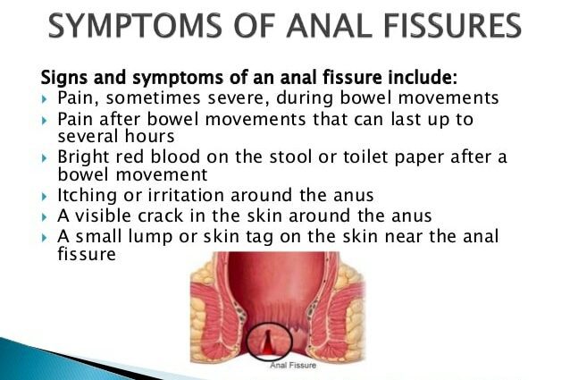 Mga sintomas at panganib na kadahilanan para sa anal fissure