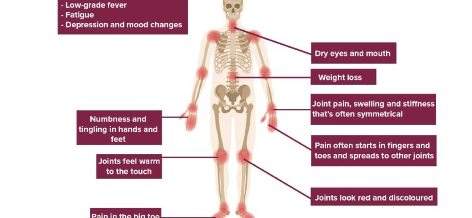 Síntomas y factores de riesgo de la artritis.