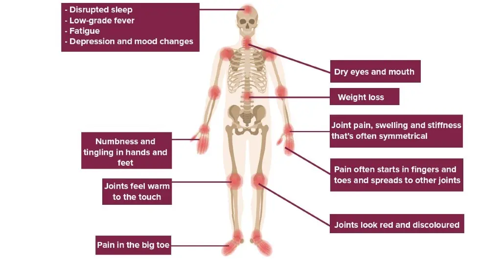 Symptoms and risk factors for arthritis