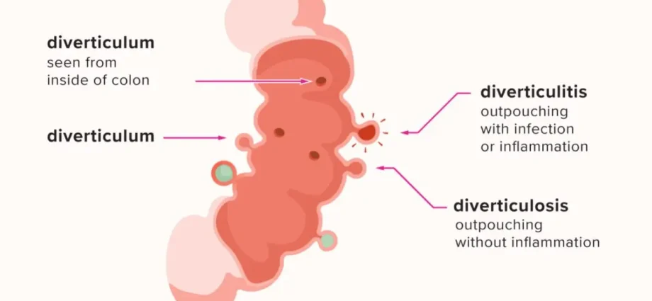 Symptoms and risk factors for diverticulitis