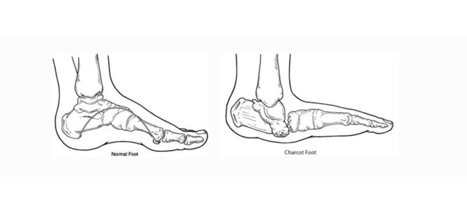 Symptoms and risks of Charcot&#8217;s disease