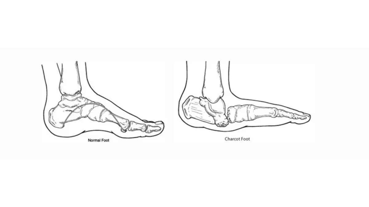 Symptoms and risks of Charcot&#8217;s disease