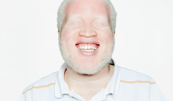 Symptoms and treatments for albinism