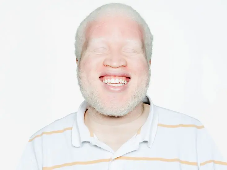 Symptoms and treatments for albinism