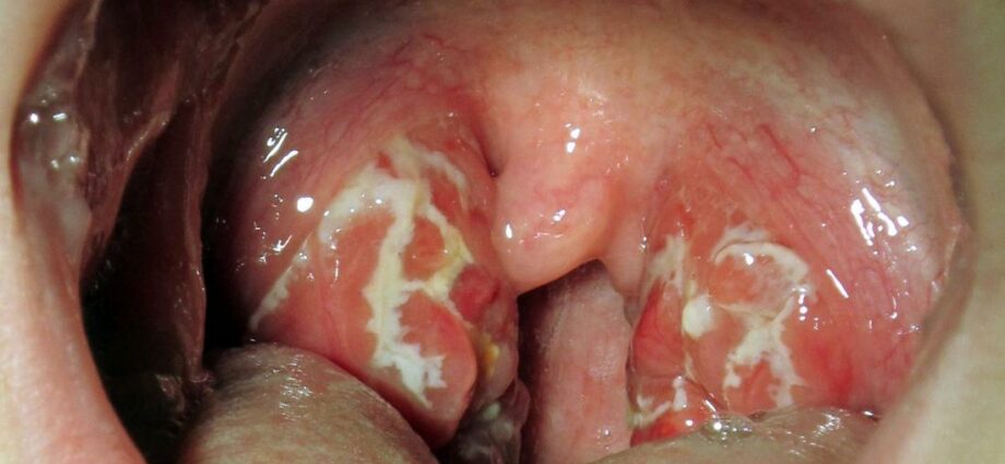 Mga simtomas ug pagtambal alang sa tonsillitis, sinusitis ug uban pang mga sakit nga ENT