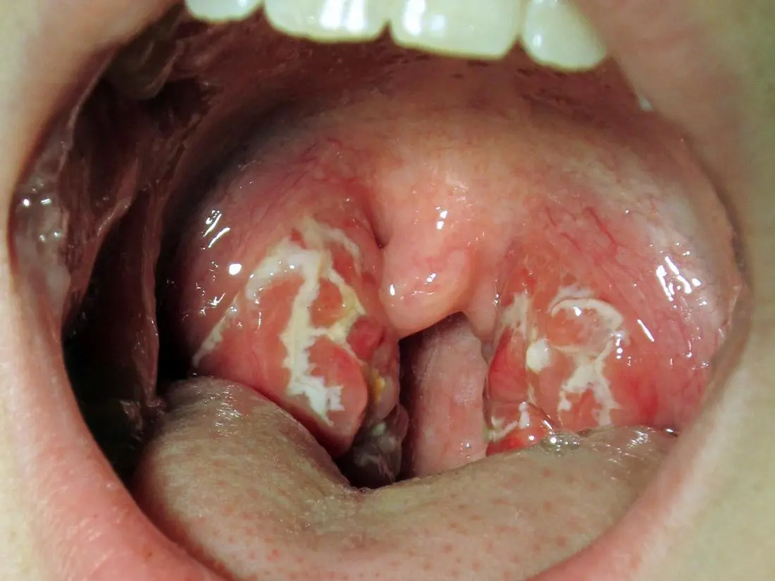 Symptoms and treatments for tonsillitis, sinusitis and other ENT diseases