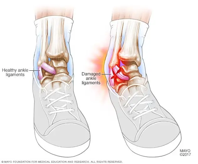 Symptoms of a sprain