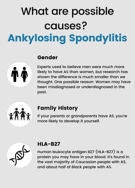 Ankylosing spondylitis (spondylitis) &#8211; Our doctor&#8217;s opinion