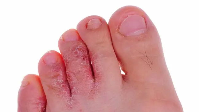 Symptoms of athlete&#8217;s foot (fungal infection)