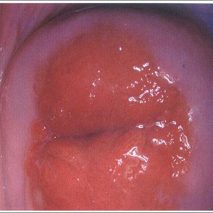Síntomas de la erosión cervical: fotos y reseñas.