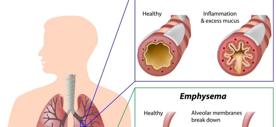 Symptoms of chronic bronchitis and emphysema (COPD)