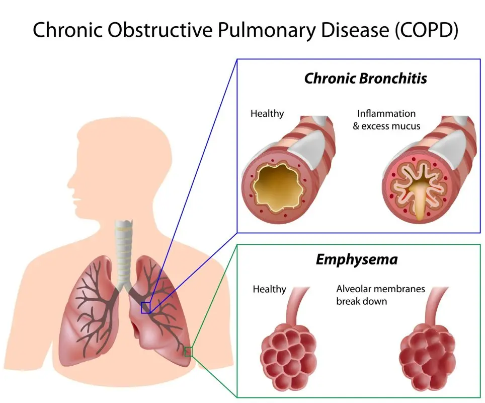 Chronic Bronchitis and Emphysema (COPD) &#8211; People and Risk Factors