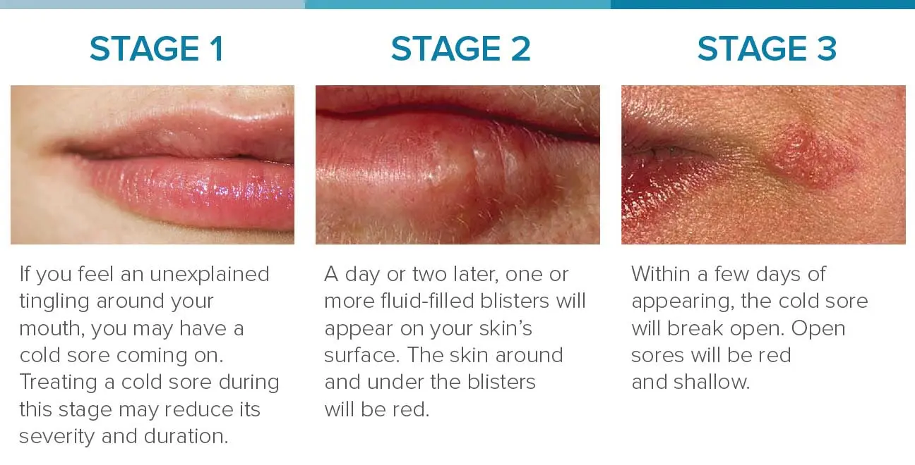 Prevention of cold sores