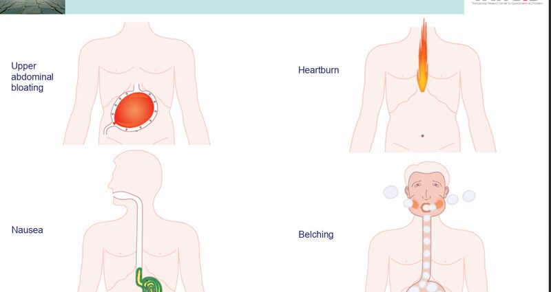 Symptoms of dyspepsia (Functional digestive disorders)