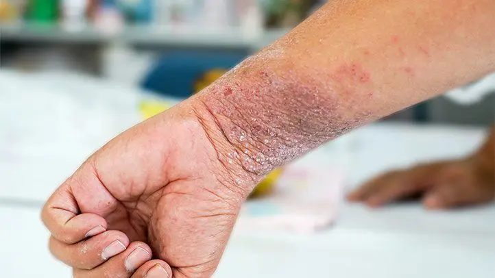 Symptoms of eczema