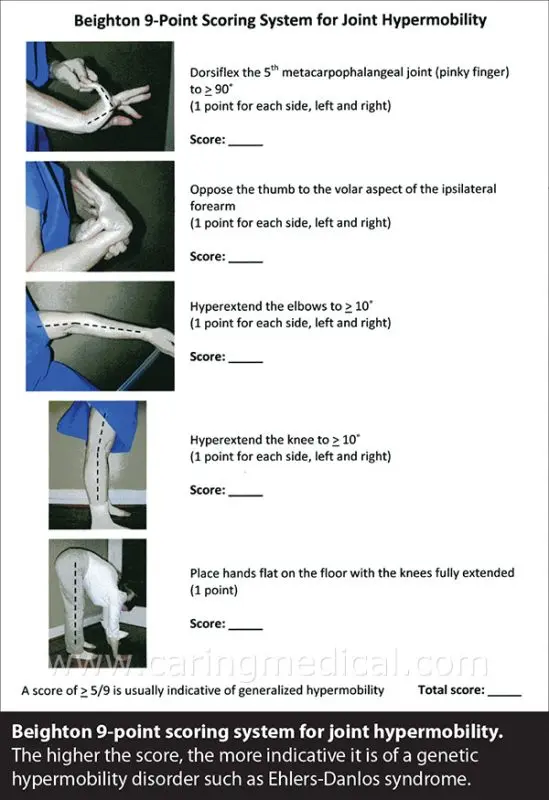 Symptoms of Ehlers-Danlos syndrome