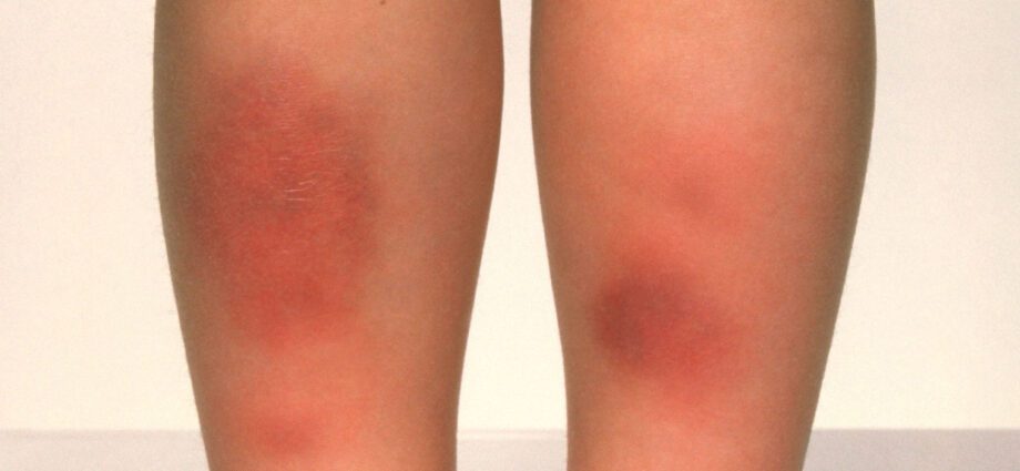 Our doctor&#8217;s opinion about erythema nodosum