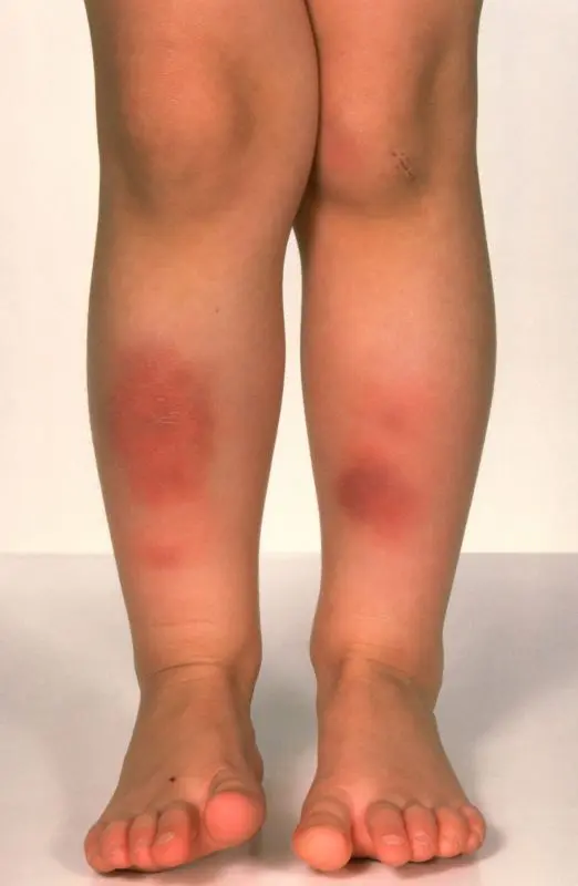 What is erythema nodosum?